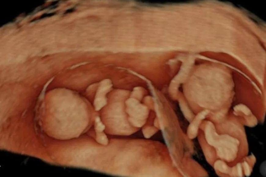 Ultrasonda Mucize; 4 Boyutlu Görüntü