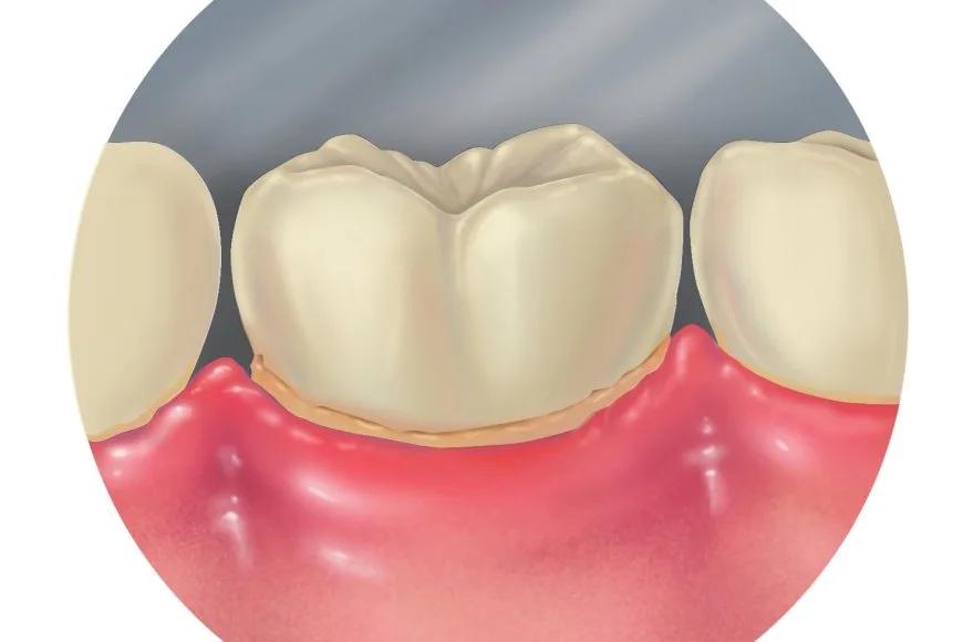 Dişeti Hastalıkları (Periodontal Hastalıklar) Nelerdir? Neden Oluşur?