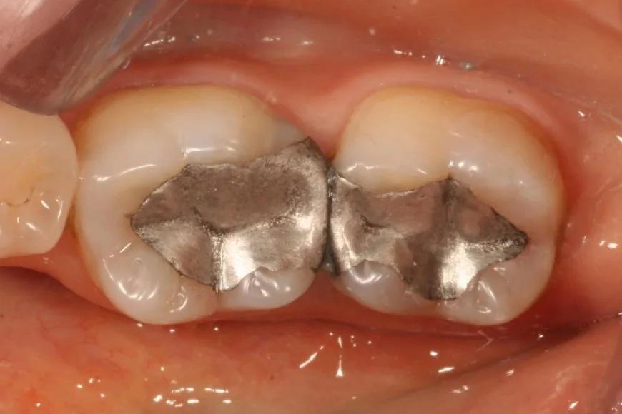 Amalgam Dolgu (Metal Dolgu) Nedir?