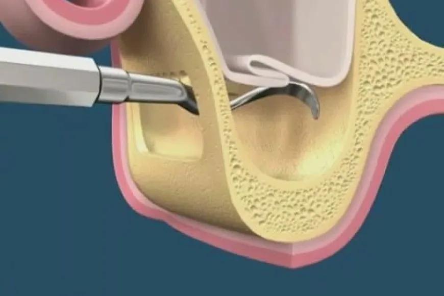Tüm Detayları ile Sinüs Lifting