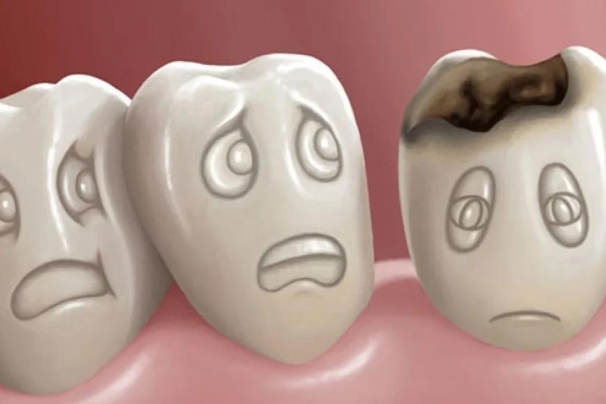 Diş Çürüğü Nedir? Nasıl Oluşur?