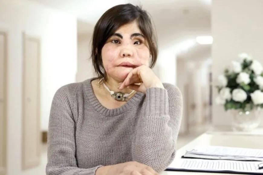 Türkiye'deki İlk Yüz Nakli Yapılan Kadın