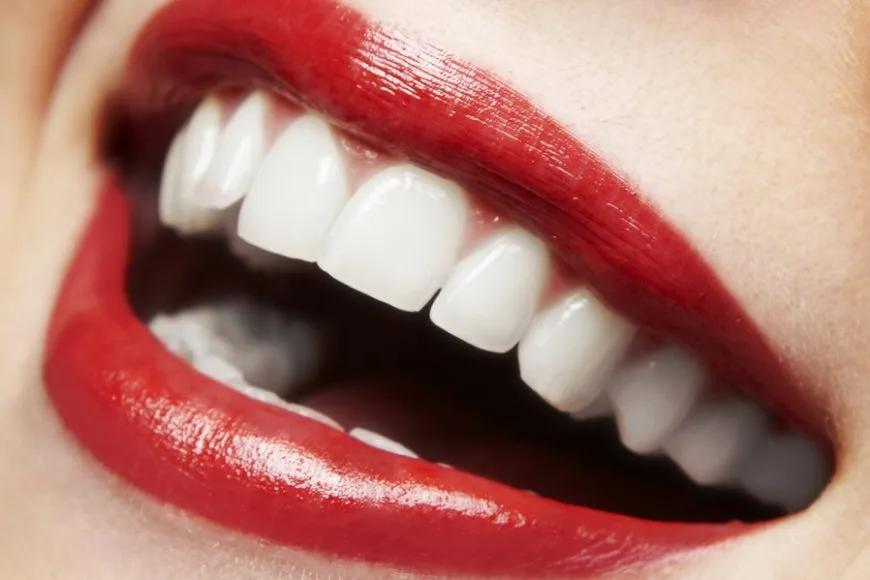 Diş Beyazlatma İşlemi (Bleaching) Nedir?