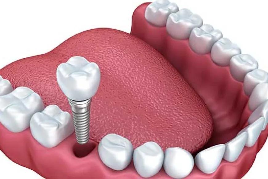 Doktor Dişine İmplant Yaptırdı, Çenesi Eriyince Korkunç Gerçek Ortaya Çıktı
