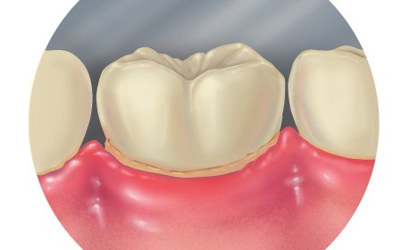 Dişeti Hastalıkları (Periodontal Hastalıklar) Nelerdir? Neden Oluşur?