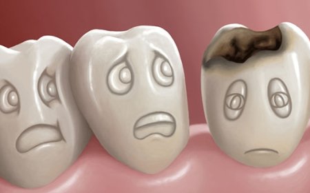 Diş Çürüğü Nedir? Nasıl Oluşur?