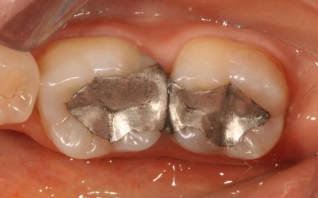 Amalgam Dolgu (Metal Dolgu) Nedir?
