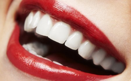 Diş Beyazlatma İşlemi (Bleaching) Nedir?