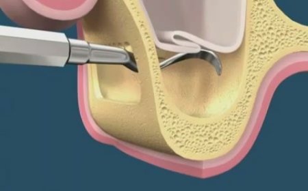 Tüm Detayları ile Sinüs Lifting