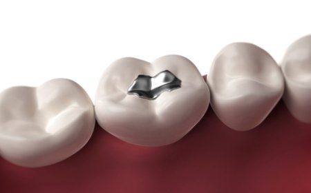 Müezzinoğlu, Amalgam Ve Kompozitin Güvenilirliğiyle İlgili Açıklama Yaptı