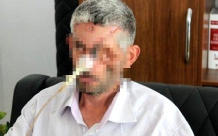 Dişini Çektirdikten Sonra Sol Gözünü Kaybetti İddiasına Yalanlama