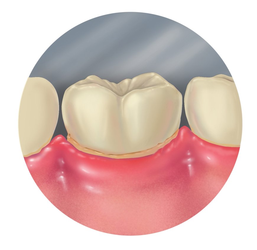 Dişeti Hastalıkları (Periodontal Hastalıklar) Nelerdir? Neden Oluşur?