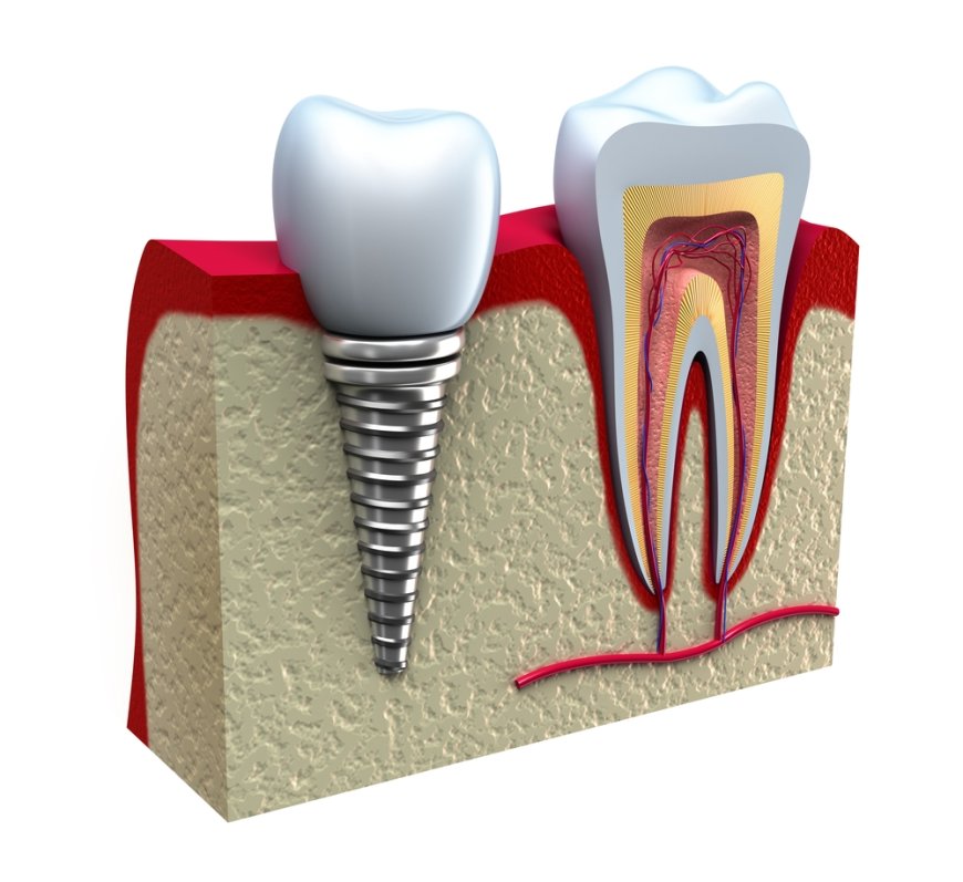 Diş Hekimlerine Ücretsiz "Periodontoloji ve Oral İmplantoloji" Eğitimi